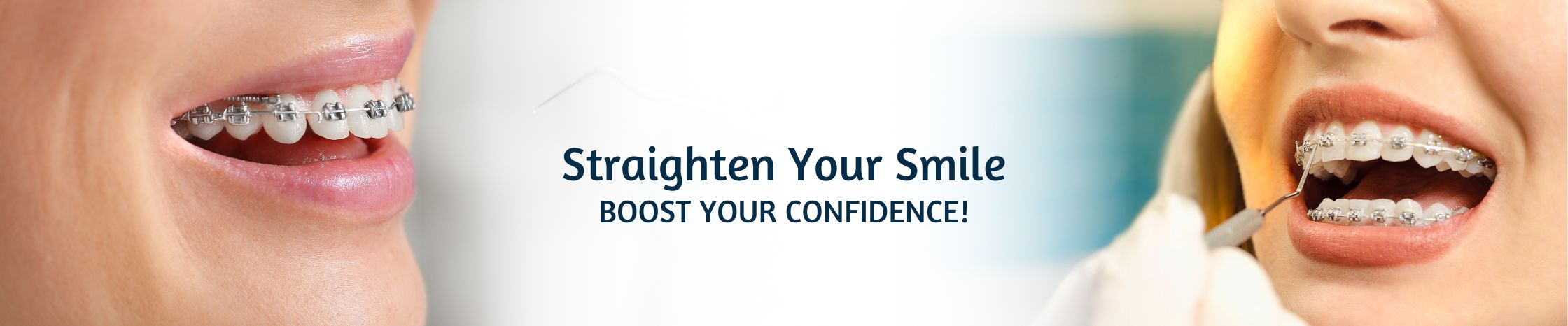 How Braces Treatment Enhances Your Confidence