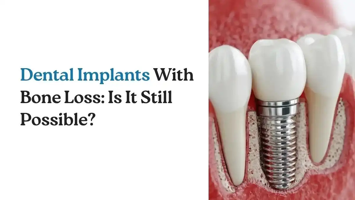 Dental Implants With Bone Loss: Is It Still Possible?