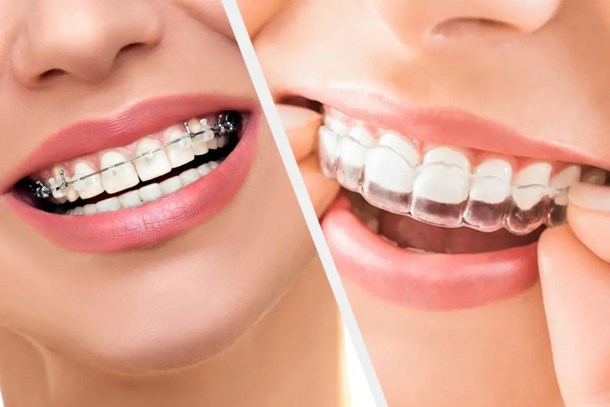 Braces and clear aligners at Vivan Dental Jaipur
