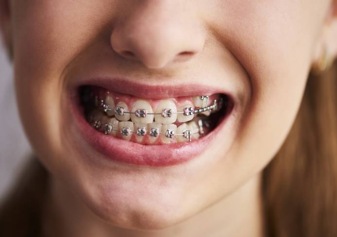 Orthodontic bite and teeth alignment assessment