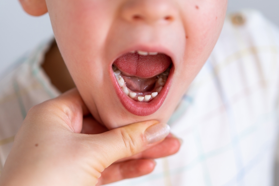 Pediatric Dentistry at Vivan Dental Vaishali Nagar