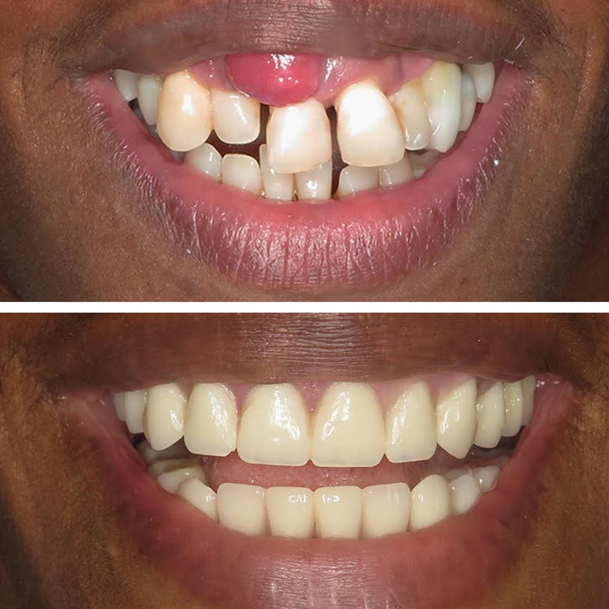 Single tooth anterior implant restoration at Vivan Dental