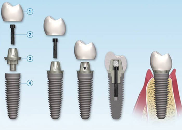 Dental Implant Procedure at Vivan Dental Vaishali Nagar
