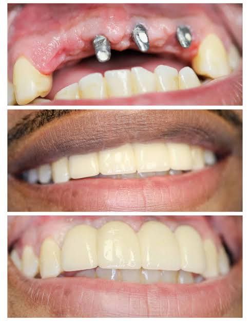 dental implant at Vivan Dental Vaishali Nagar