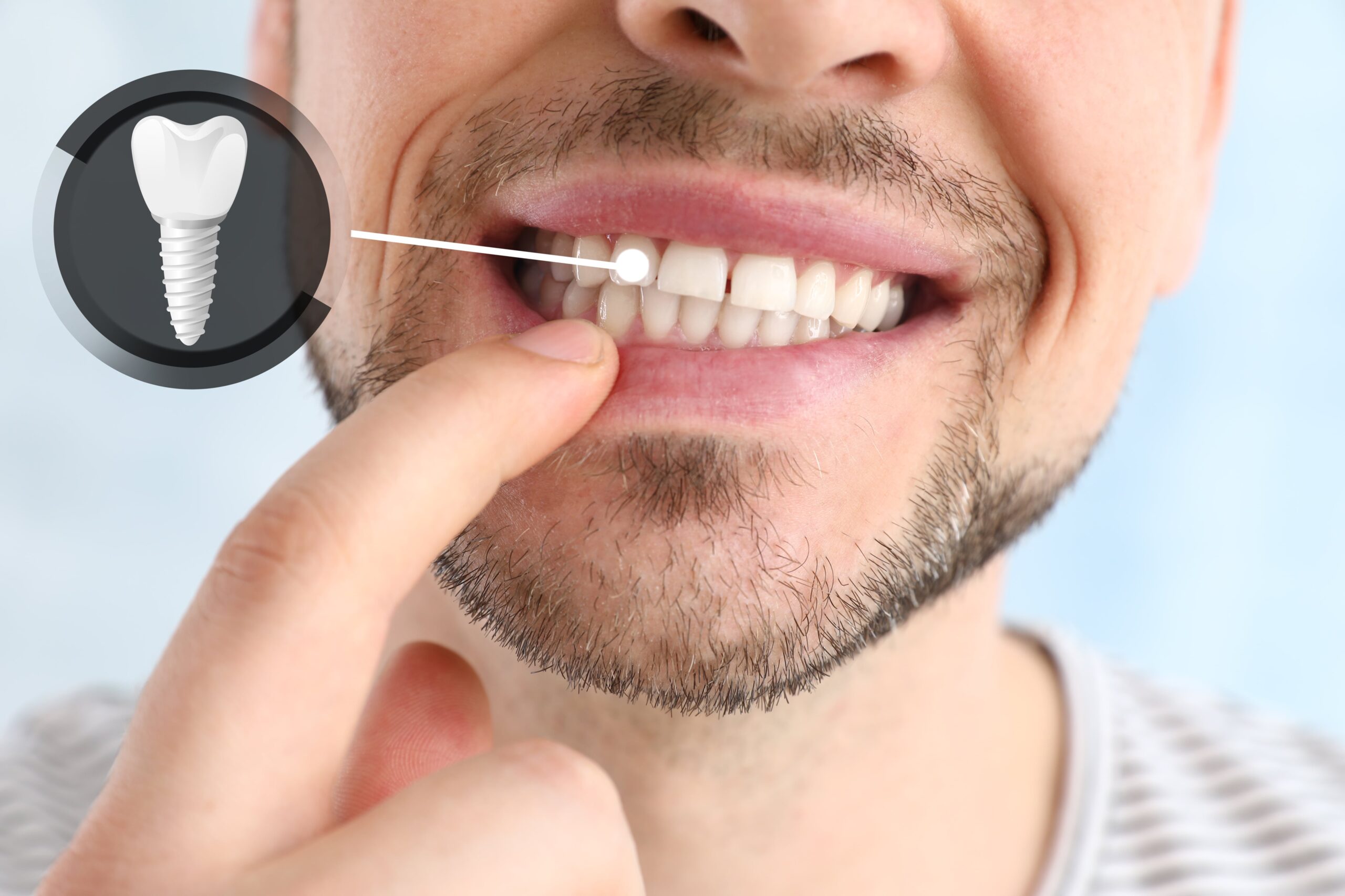 dental implant at Vivan Dental Vaishali Nagar
